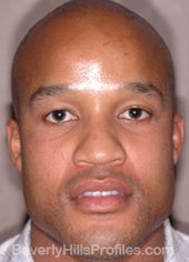 AFRICAN AMERICAN RHINOPLASTY - Before Treatment Photo: male front view, patient 2