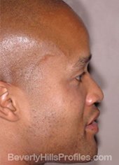 AFRICAN AMERICAN RHINOPLASTY - Before Treatment Photo: male right side view, patient 2