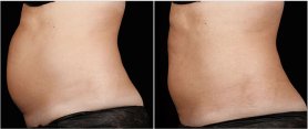Female tummy, before and after sculpsure treatment, left side view
