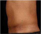 Male tummy, after SculpSure treatment, patient 2 (left side view)
