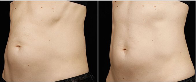 SculpSure Before and After Photos: female, left side oblique view, patient 5