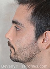 Male fece, after Rhinoplasty Mistakes treatment, left side view - patient 1