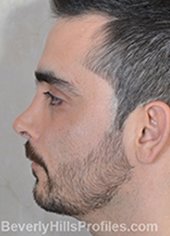Male fece, before Rhinoplasty Mistakes treatment, left side view - patient 1