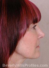 Female fece, after Rhinoplasty Mistakes treatment, right side view - patient 2