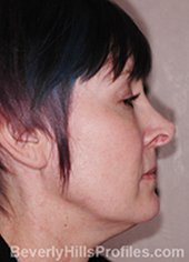 Female fece, before Rhinoplasty Mistakes treatment, right side view - patient 2