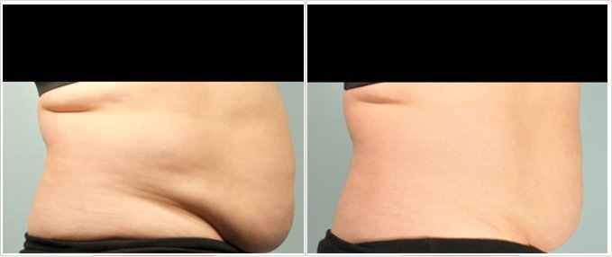 SculpSure Before and After Photos: female, right side view, patient 11