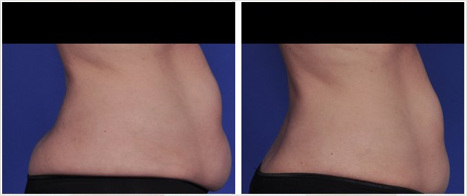 SculpSure Before and After Photos: female, right side view, patient 12