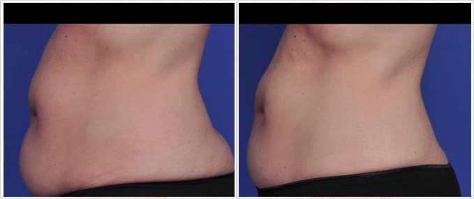 SculpSure Before and After Photos: female, left side view, patient 13
