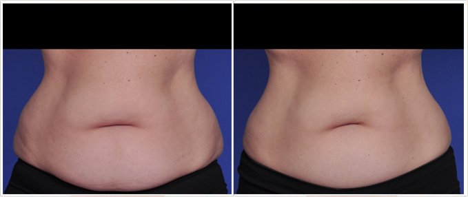 SculpSure Before and After Photos: female, front view, patient 14