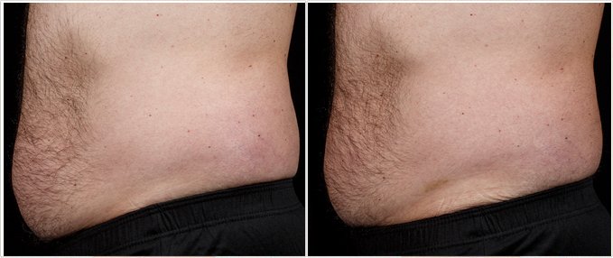 SculpSure Before and After Photos: male, left side view, patient 16