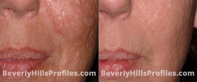 Female face, before and after SURGICAL SCARS REMOVAL Treatment