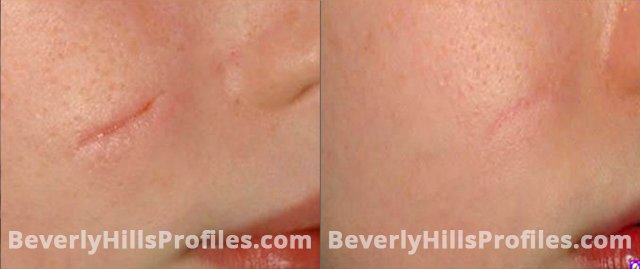 Acne Surgical Scars Before and After Photos - female patient 2