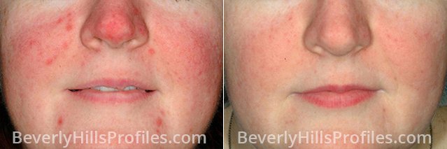 Rosacea Before and After Photos: female, front view, patient 2