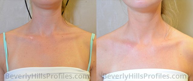 Sun Damage Before and After Photos: female patient, front view