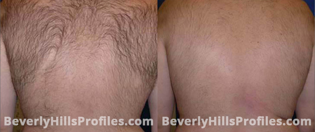 Unwanted Hair Before and After Photos: back view, male patient 2