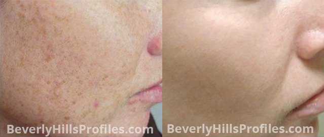 Facial Vessels and Pigments Before and After Photo Gallery - female, right side view, patient 3