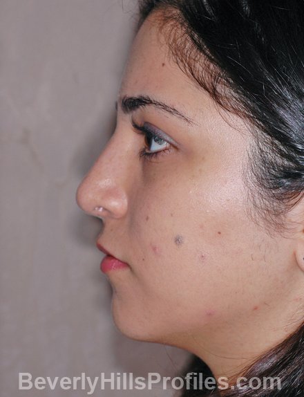 Rhinoplasty After Photo - female, side view