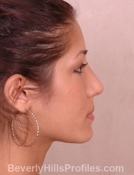 Ethnic Rhinoplasty After Treatment Photo - female, right side view, patient 3