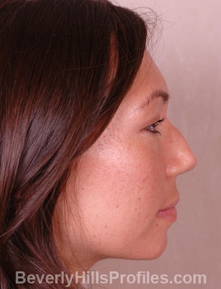 Rhinoplasty Before - female, side view