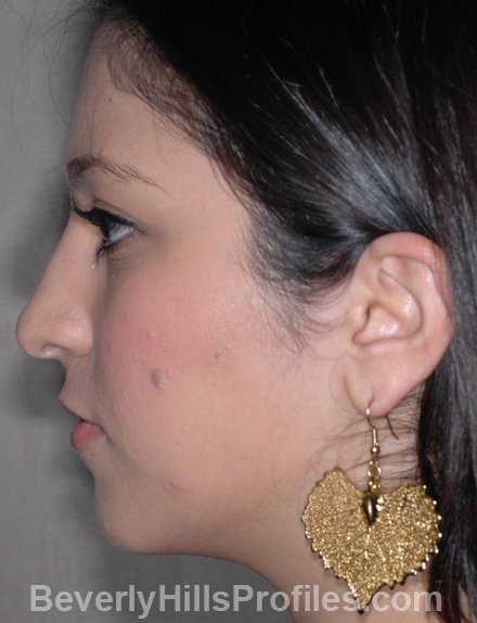 Nose Job Before - female, side view