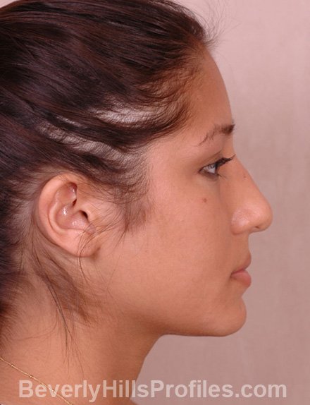 Nose Job Before Photo - female, side view