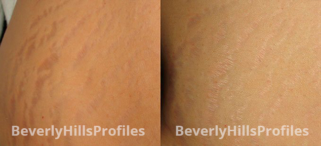 Stretch Marks Before and After Photos - female patient 2