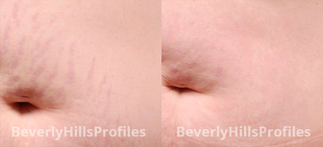 Stretch Marks Before and After Photos - female patient 3