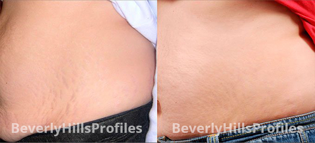 Stretch Marks Before and After Photos - female patient 4