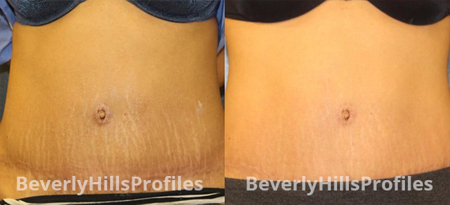 Stretch Marks Before and After Photos - female patient 5
