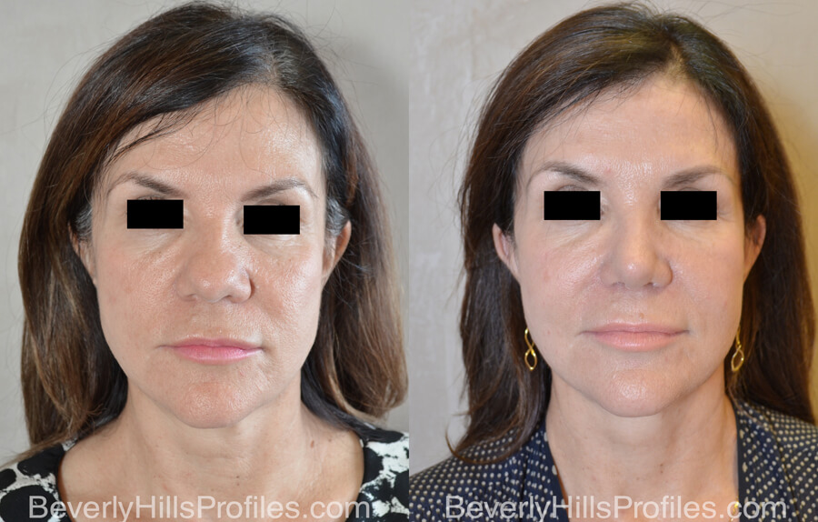 Facial Fat Transfer Before and After Photo Gallery - female, front view,patient 14
