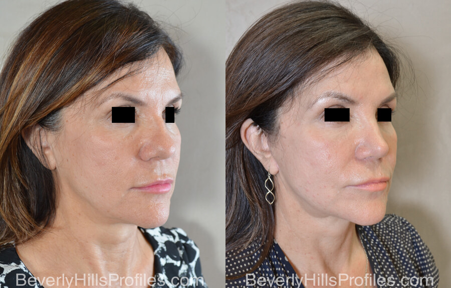 Facial Fat Transfer Before and After Photo Gallery - female, right oblique view