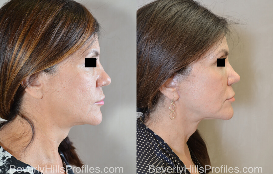 Facial Fat Transfer Before and After Photo Gallery - female, right side view