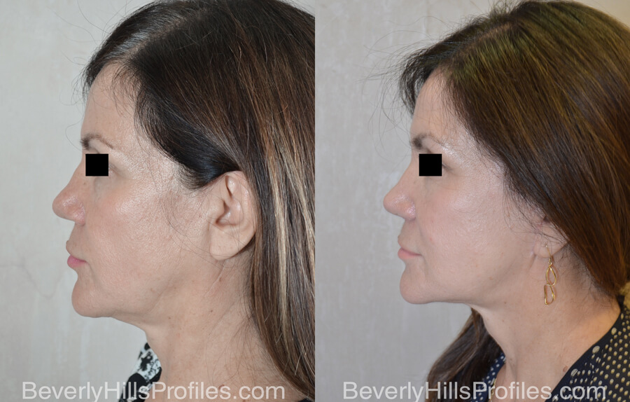 Facial Fat Transfer Before and After Photo Gallery - female, side view