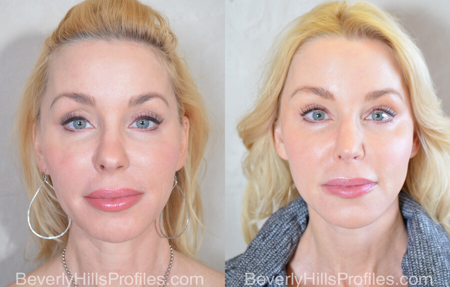 Facial Fat Transfer Before & After Photos