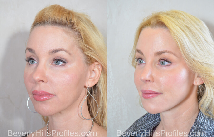 Facial Fat Transfer Before and After Photo - female, oblique view