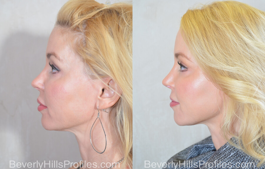 Facial Fat Transfer Before and After Photo - female, side view