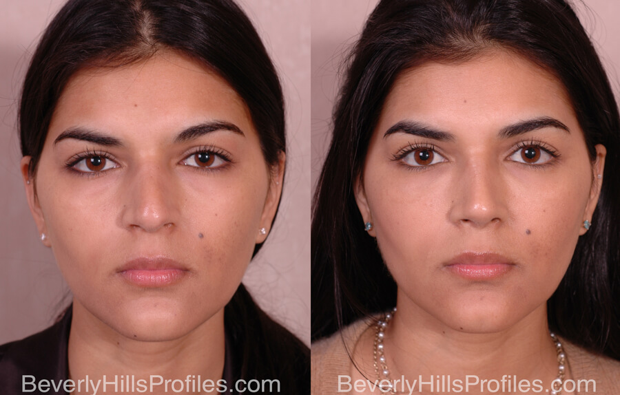 Facial Fat Transfer Before and After Photo Gallery - female, front view,patient 16