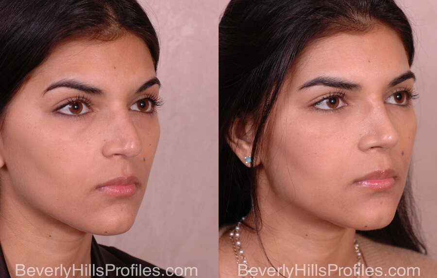 Facial Fat Transfer Before and After - female, right oblique view