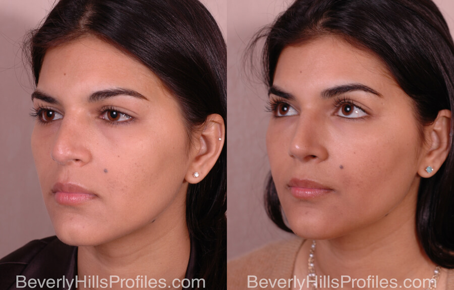 Facial Fat Transfer Before and After - female, oblique view