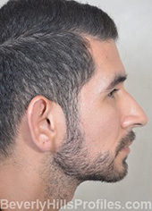 Otoplasty Before Photo - male, side view
