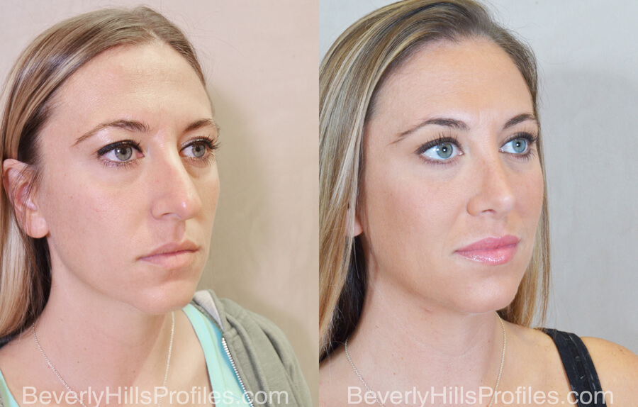 Rhinoplasty Before and After - female, right oblique view