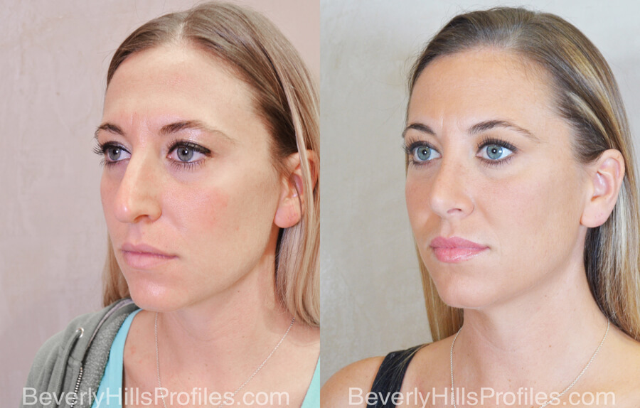 Rhinoplasty Before and After - female, oblique view