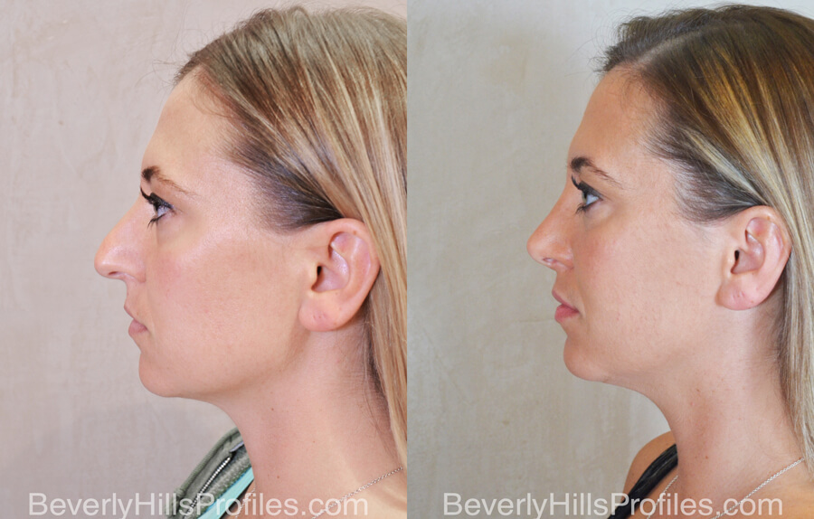 Rhinoplasty Before and After - female, side view