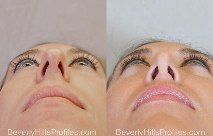 Rhinoplasty Before and After - female, bottom view