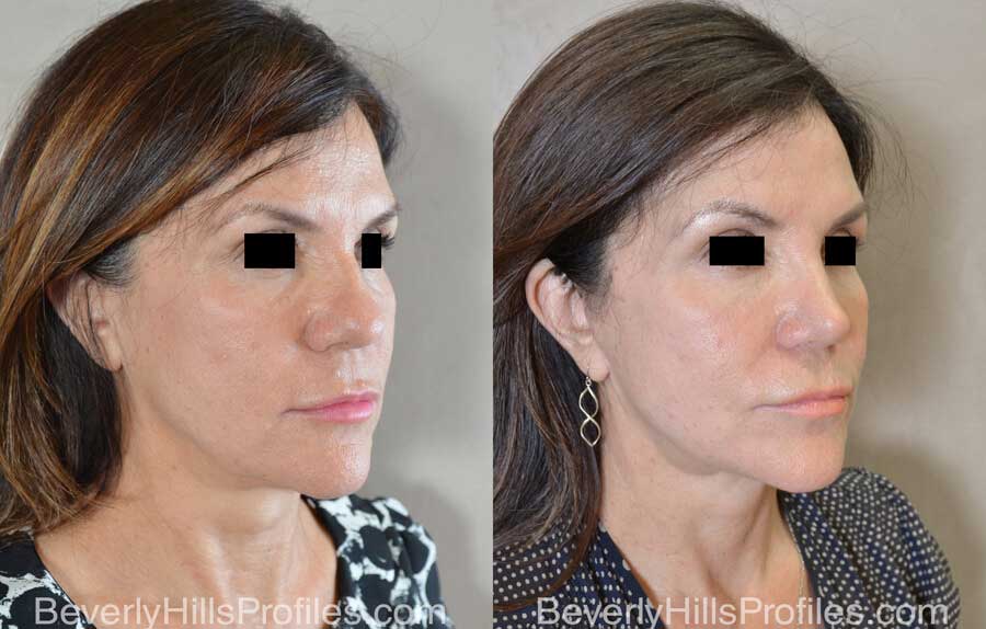 Rhinoplasty Before After - female, right oblique view