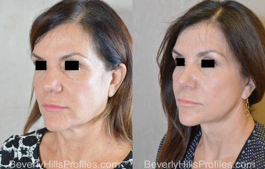 Rhinoplasty Before After - female, oblique view