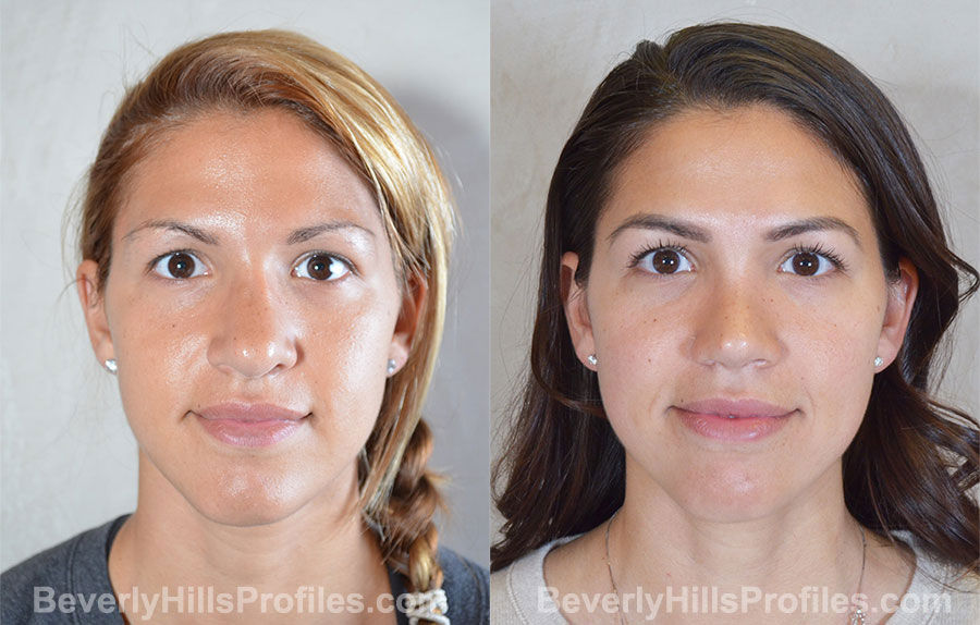 Revision Rhinoplasty Before and After Photo Gallery - front view, female patient 36