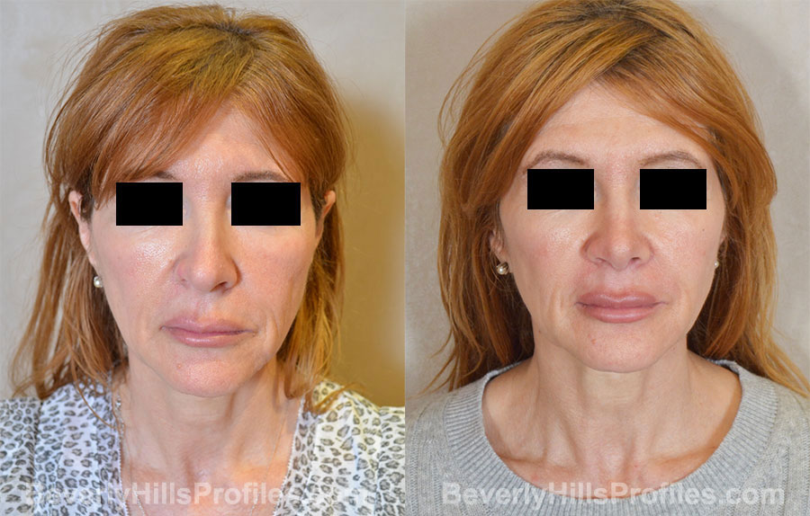 Rhinoplasty Before and After Photo Gallery - female, front view