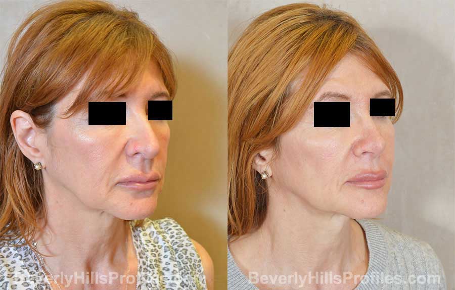 Rhinoplasty Before and After Photo Gallery - female, right oblique view