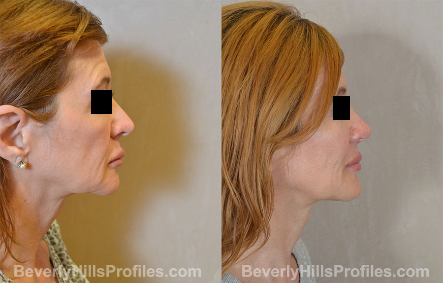 Rhinoplasty Before and After Photo Gallery - female, right side view